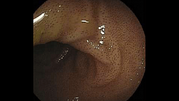 Меланоз подвздошной кишки